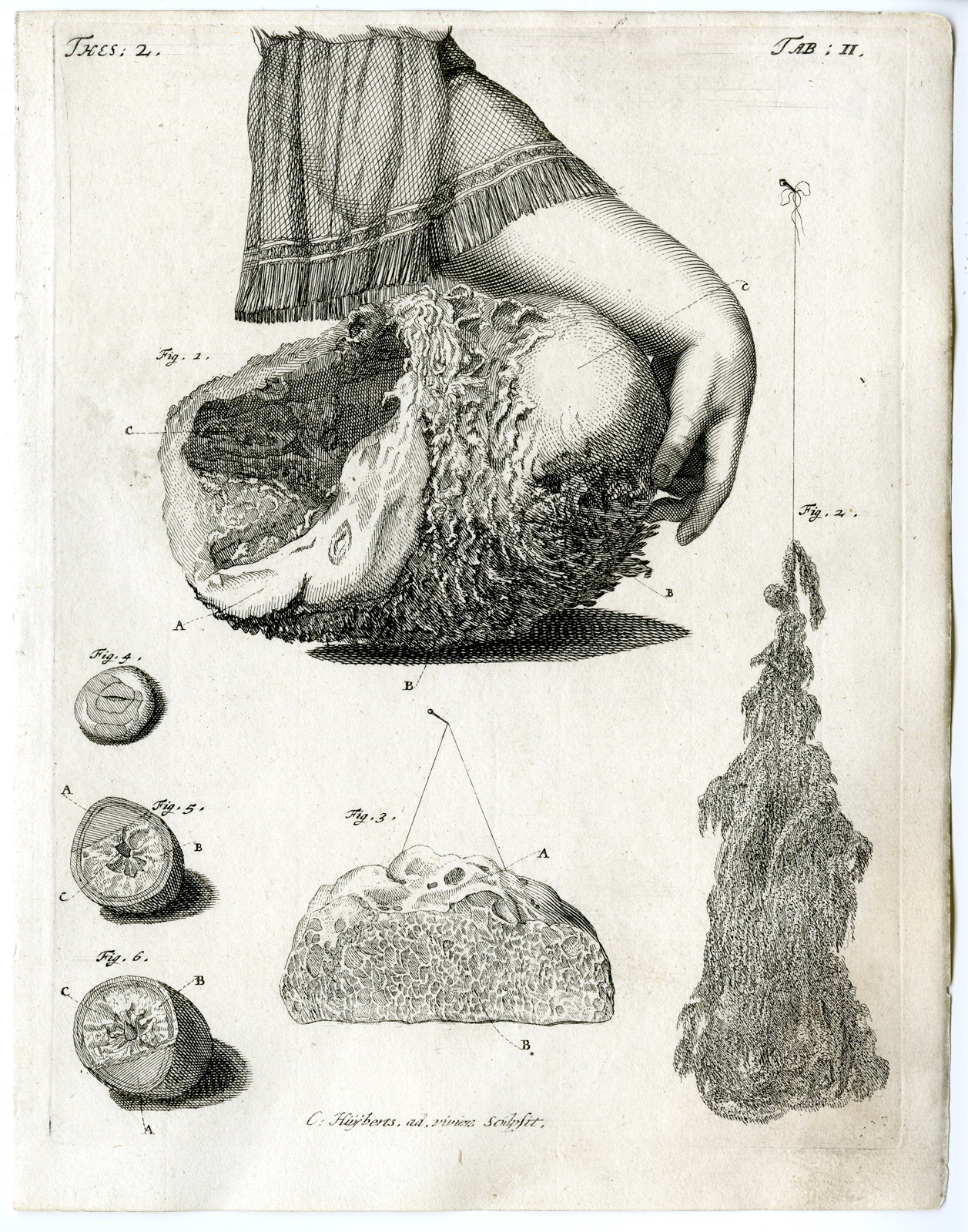 , Antique Print – BLADDER-HUMAN-PREGNANT-DROPSICAL LIVER-TAB.II-HUIJBERTS after RUYSCH – 1701, Pictura Antique Prints