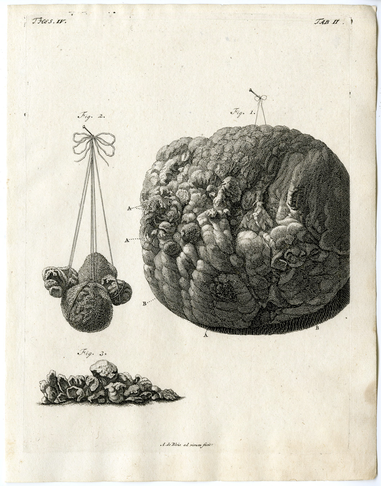 , Antique Print – ANATOMY-BLADDER-COW-SURFACE-STONE-TAB II-DE BLOIS after RUYSCH – 1701, Pictura Antique Prints