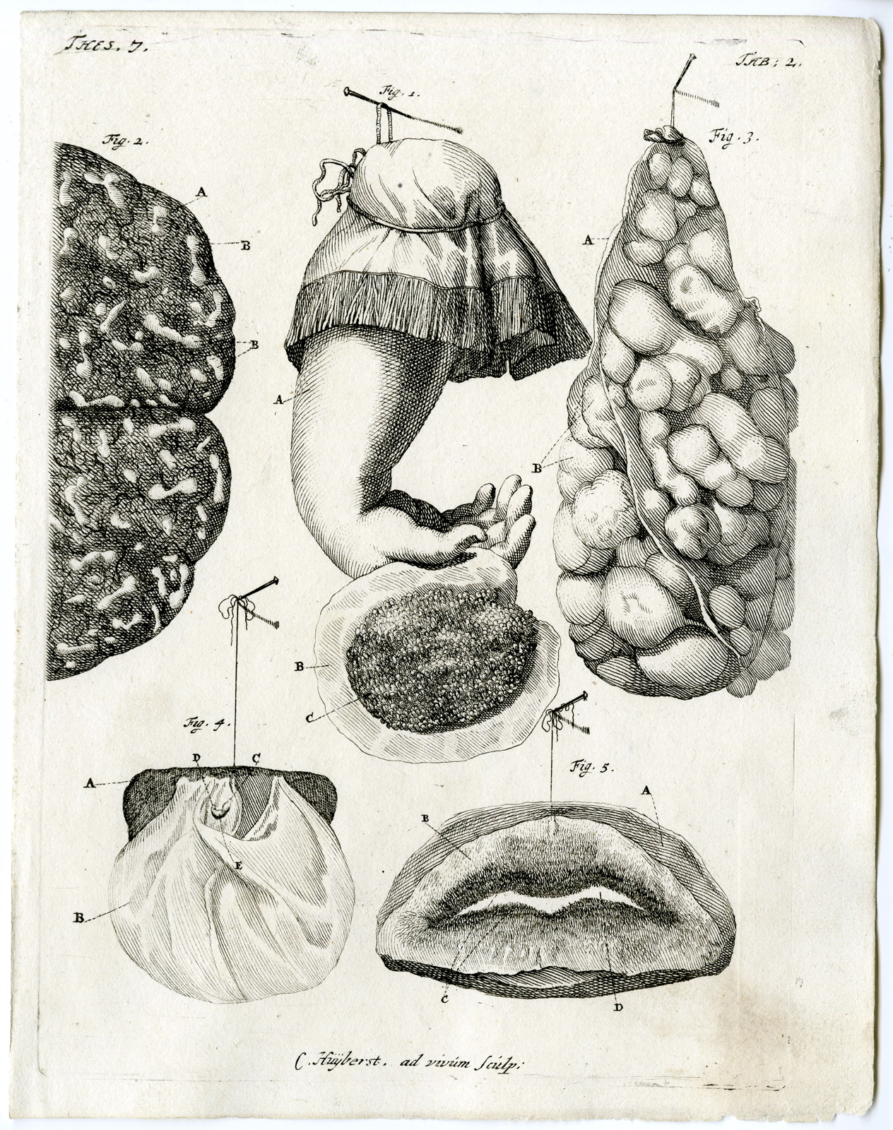 , Antique Print – ANATOMY-BRAIN-EDEMA-PERITONEUM-PLACENTA-T.2-HUIJBERTS after RUYSCH – 1701, Pictura Antique Prints
