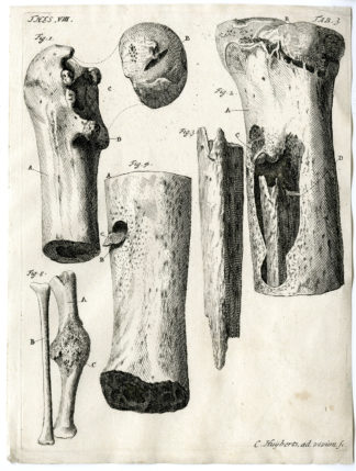 Antique Print - ANATOMY-HUMAN LEG BONES-CARIES-DUCK-TAB.3-HUIJBERTS after RUYSCH - 1701