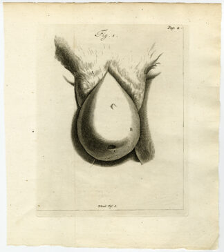 Antique Print-ANATOMY-UTERINE PROLAPSE-WOMB-FIG 1-Ruysch-Huyberts-1744
