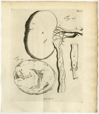 Antique Print-SUPERFOETATIO-EMBRYO-KIDNEY-STONE-FIG 15-16-Ruysch-Huyberts-1744