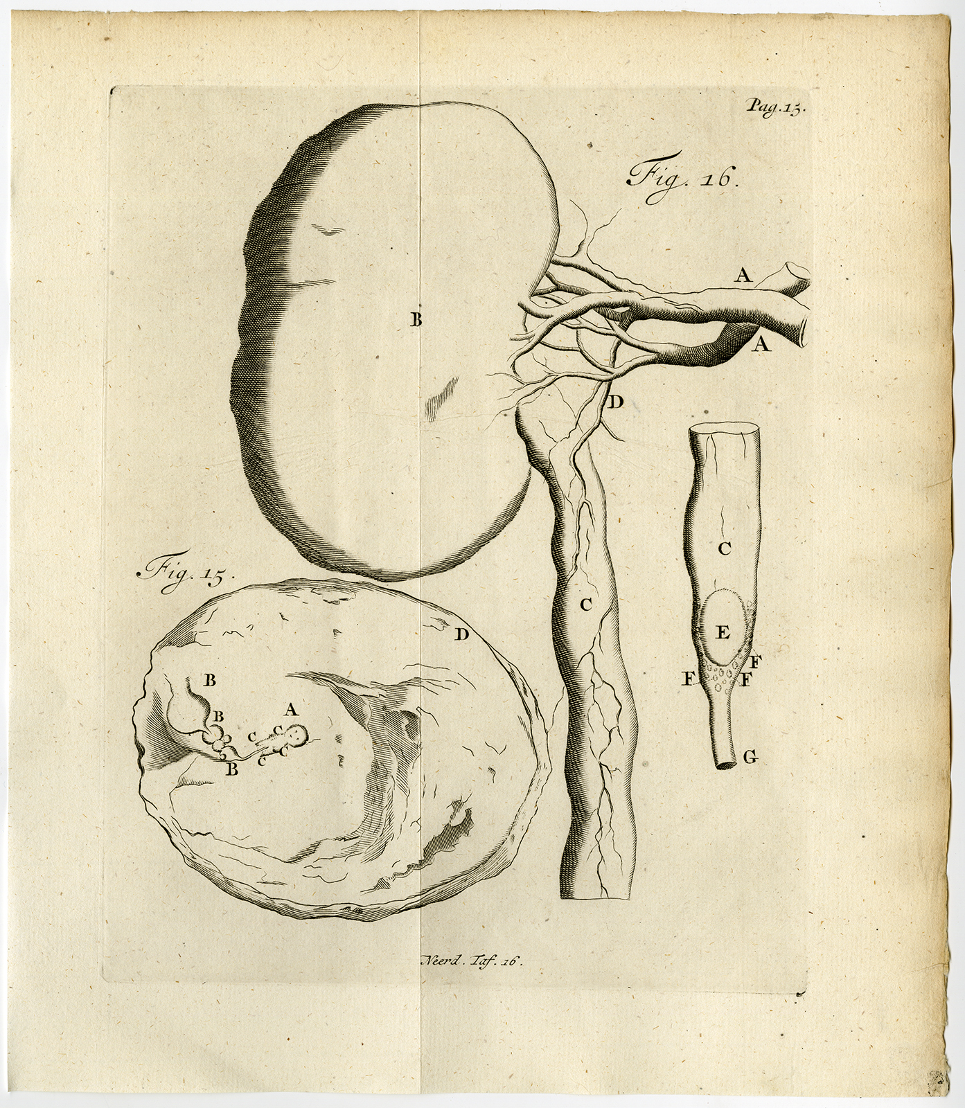 , Antique Print-SUPERFOETATIO-EMBRYO-KIDNEY-STONE-FIG 15-16-Ruysch-Huyberts-1744, Pictura Antique Prints