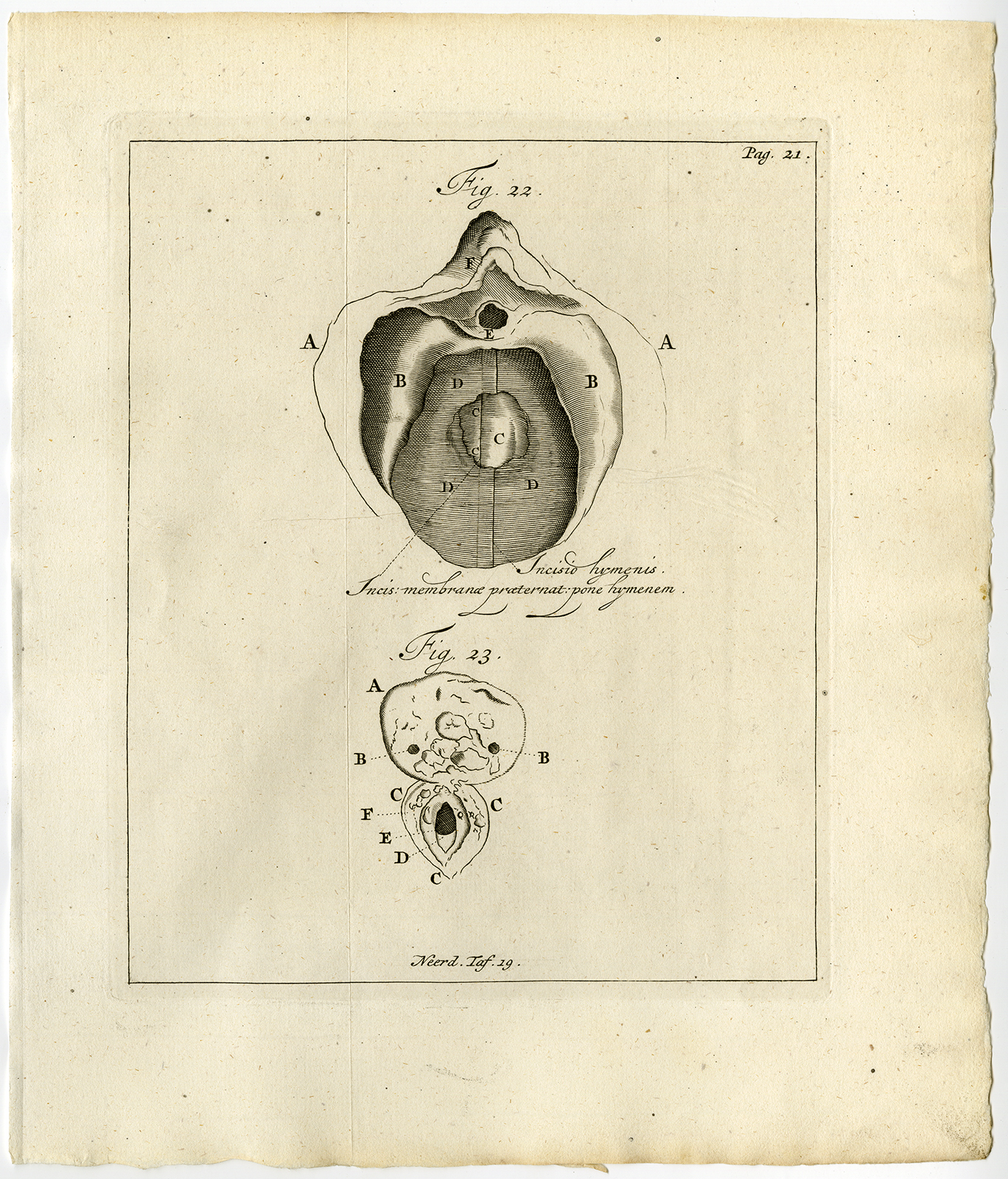 , Antique Print-VAGINA-REPRODUCTIVE ORGAN-DEFORMATION-Ruysch-Huyberts-1744, Pictura Antique Prints
