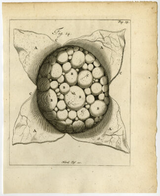 Antique Print-ASCITES-PERITONEAL FLUID EXCESS-FIG 24-Ruysch-Huyberts-1744