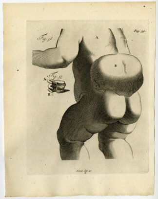 Antique Print-CHILD-TUMOR-CANCEROUS GROWTH-Ruysch-Huyberts-1744