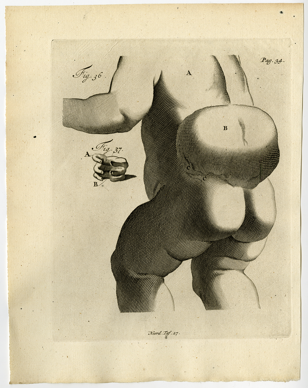 , Antique Print-CHILD-TUMOR-CANCEROUS GROWTH-Ruysch-Huyberts-1744, Pictura Antique Prints