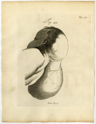 Antique Print-HYDROCEPHALUS-NEWBORN-CHILD-FIG 45-Ruysch-Huyberts-1744