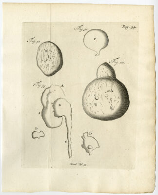 Antique Print-KIDNEY-WOMB-TUMOROUS GROWTH-Ruysch-Huyberts-1744