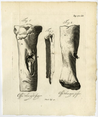 Antique Print-SHIN BONE-CARIES-DEFORMATION-FIG 6-8-Ruysch-Huyberts-1744