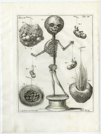 Antique Print-HUMAN SKELETON-EMBRYO-TUMOUR-HAIRY-TAB 3-Ruysch-Huyberts-1744