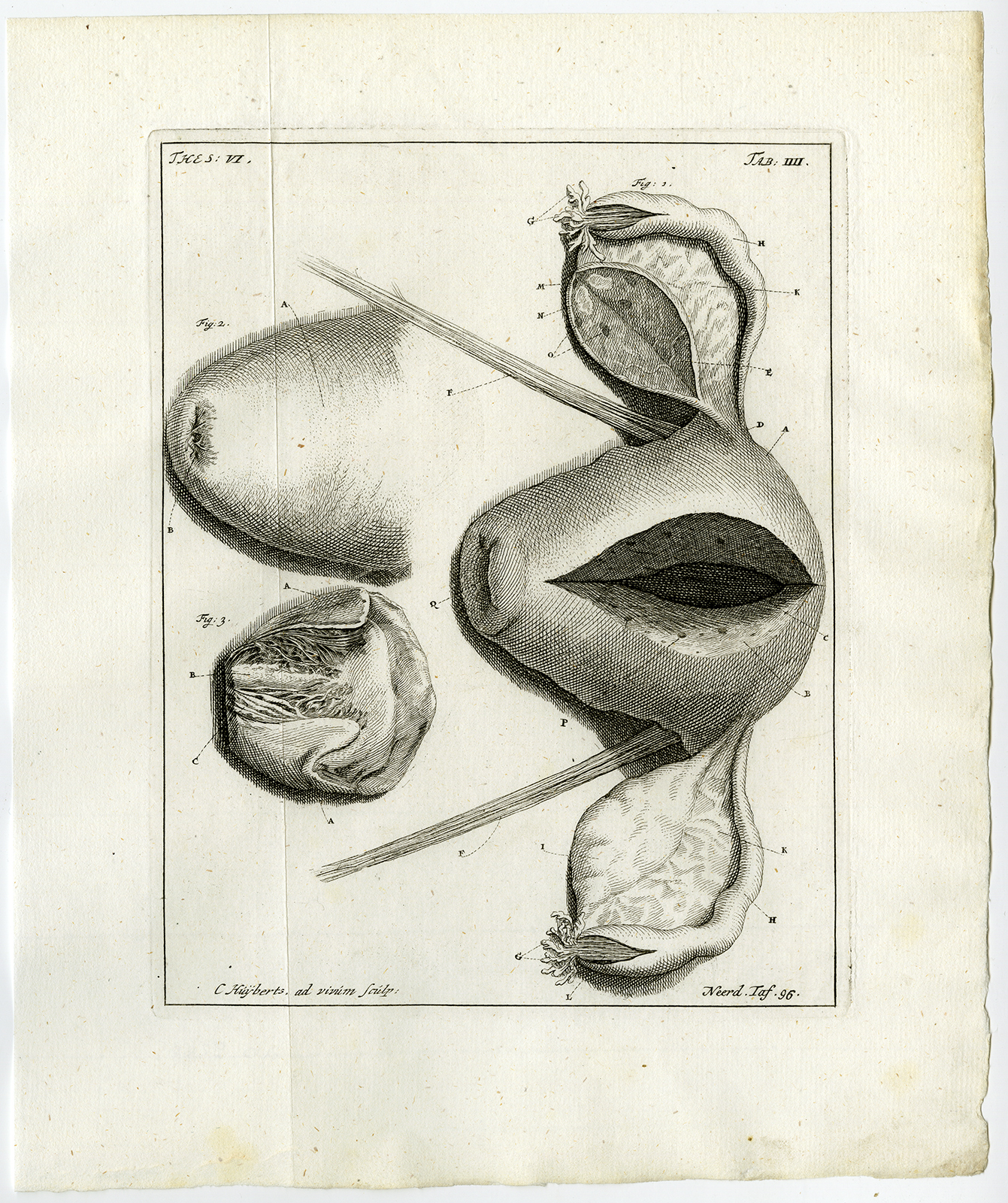 , Antique Print-WOMB-IMPREGNATE-UTERINE PROLAPSE-CERVIX UTERI-Ruysch-Huyberts-1744, Pictura Antique Prints