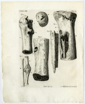 Antique Print-HUMAN LEG BONES-CARIES-DUCK WING BONE-TAB 3-Ruysch-Huyberts-1744