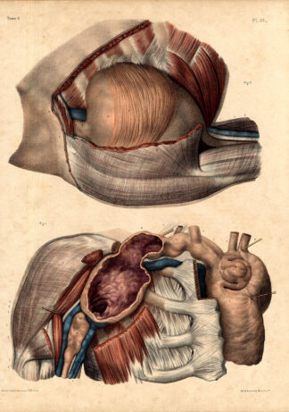 Antique Medical Anatomy Print-ANEURISM-AXILLARY ARTERY-Pl. 32-Bourgery-1831