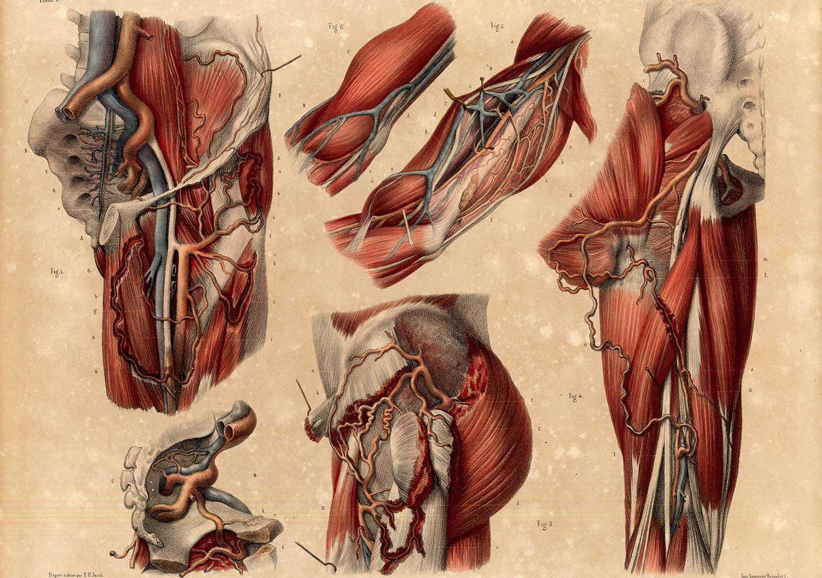 , Antique Medical Anatomy Print-LIGATURE-ARTERIAL TRUNKS-Pl. 33bis-Bourgery-1831, Pictura Antique Prints
