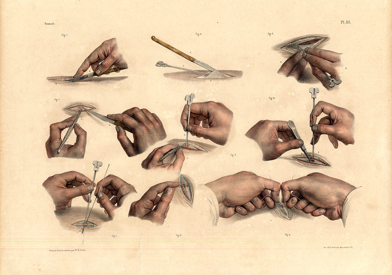 , Antique Medical Anatomy Print-LIGATURE-ARTERY-OPERATION-Pl. 35-Bourgery-1831, Pictura Antique Prints