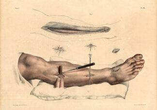 Antique Medical Anatomy Print-LIGATURE-TIBIAL ARTERY-FOOT-Pl. 36-Bourgery-1831