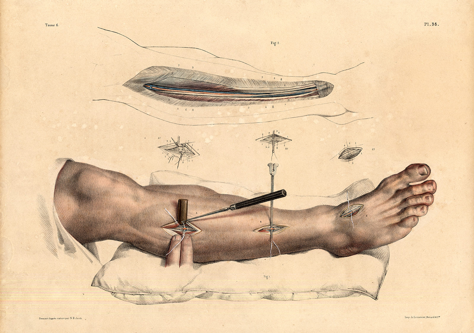 , Antique Medical Anatomy Print-LIGATURE-TIBIAL ARTERY-FOOT-Pl. 36-Bourgery-1831, Pictura Antique Prints