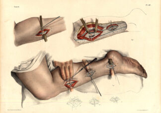 Antique Medical Anatomy Print-LIGATURE-TIBIAL ARTERY-Pl. 37-Bourgery-1831