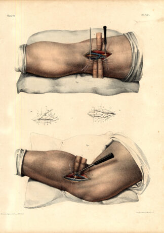 Antique Medical Anatomy Print-LIGATURE-POPLITEAL ARTERY-Pl. 38-Bourgery-1831