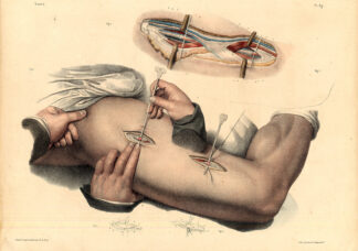 Antique Medical Anatomy Print-LIGATURE-FEMORAL ARTERY-Pl. 39-Bourgery-1831