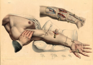 Antique Medical Anatomy Print-LIGATURE-CUBITAL ARTERY-Pl. 40-Bourgery-1831
