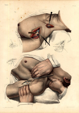 Antique Medical Anatomy Print-LIGATURE-SUBCLAVIAN ARTERY-Pl. 42-Bourgery-1831
