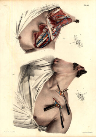 Antique Medical Anatomy Print-LIGATURE-AXILLARY ARTERY-Pl. 43-Bourgery-1831