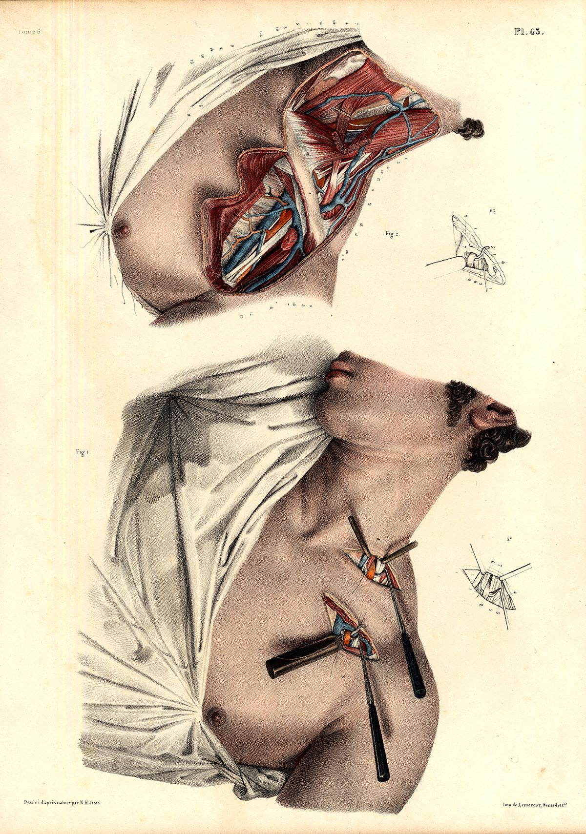 , Antique Medical Anatomy Print-LIGATURE-AXILLARY ARTERY-Pl. 43-Bourgery-1831, Pictura Antique Prints