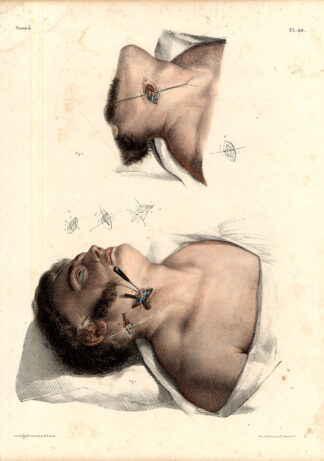 Antique Medical Anatomy Print-LIGATURE-OCCIPITAL ARTERY-Pl. 44-Bourgery-1831