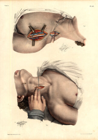 Antique Medical Anatomy Print-LIGATURE-SUBCLAVIAN ARTERY-Pl. 45-Bourgery-1831