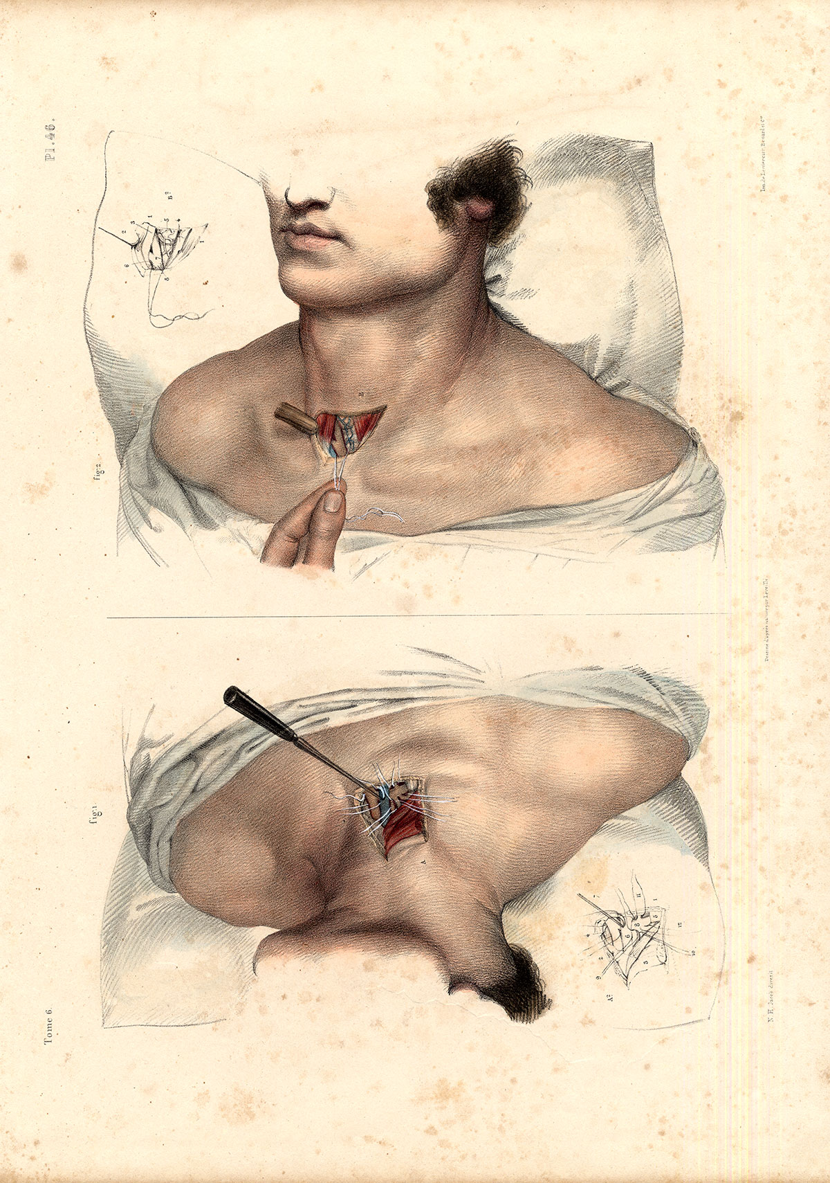 , Antique Medical Anatomy Print-LIGATURE-BRACHIOCEPHALIC TRUNC-P. 46-Bourgery-1831, Pictura Antique Prints