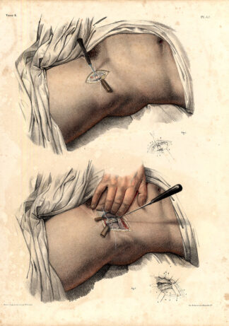 Antique Medical Anatomy Print-LIGATURE-ILIAC ARTERY-FEMORAL-Pl. 47-Bourgery-1831