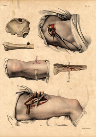 2 Antique Medical Anatomy Prints-FRACTURE HEALING-BONES-Pl. 49-Bourgery-1831