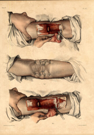 2 Antique Medical Anatomy Prints-RESECTION-HUMERO CUBITAL-Pl. 57-Bourgery-1831