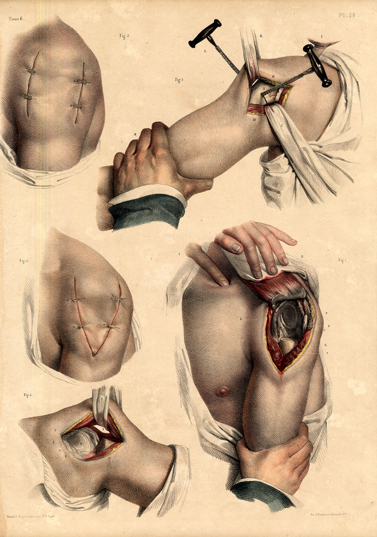 , 2 Antique Medical Anatomy Prints-RESECTION-HUMERO CUBITAL-Pl. 57-Bourgery-1831, Pictura Antique Prints