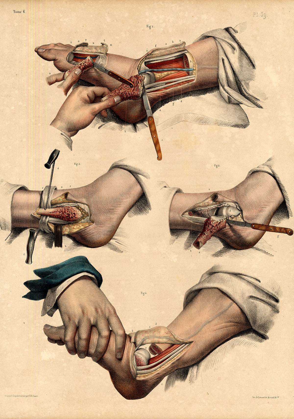 , 2 Antique Medical Anatomy Prints-RESECTION-TIBIOTARSAL JOINT-Pl 59-Bourgery-1831, Pictura Antique Prints