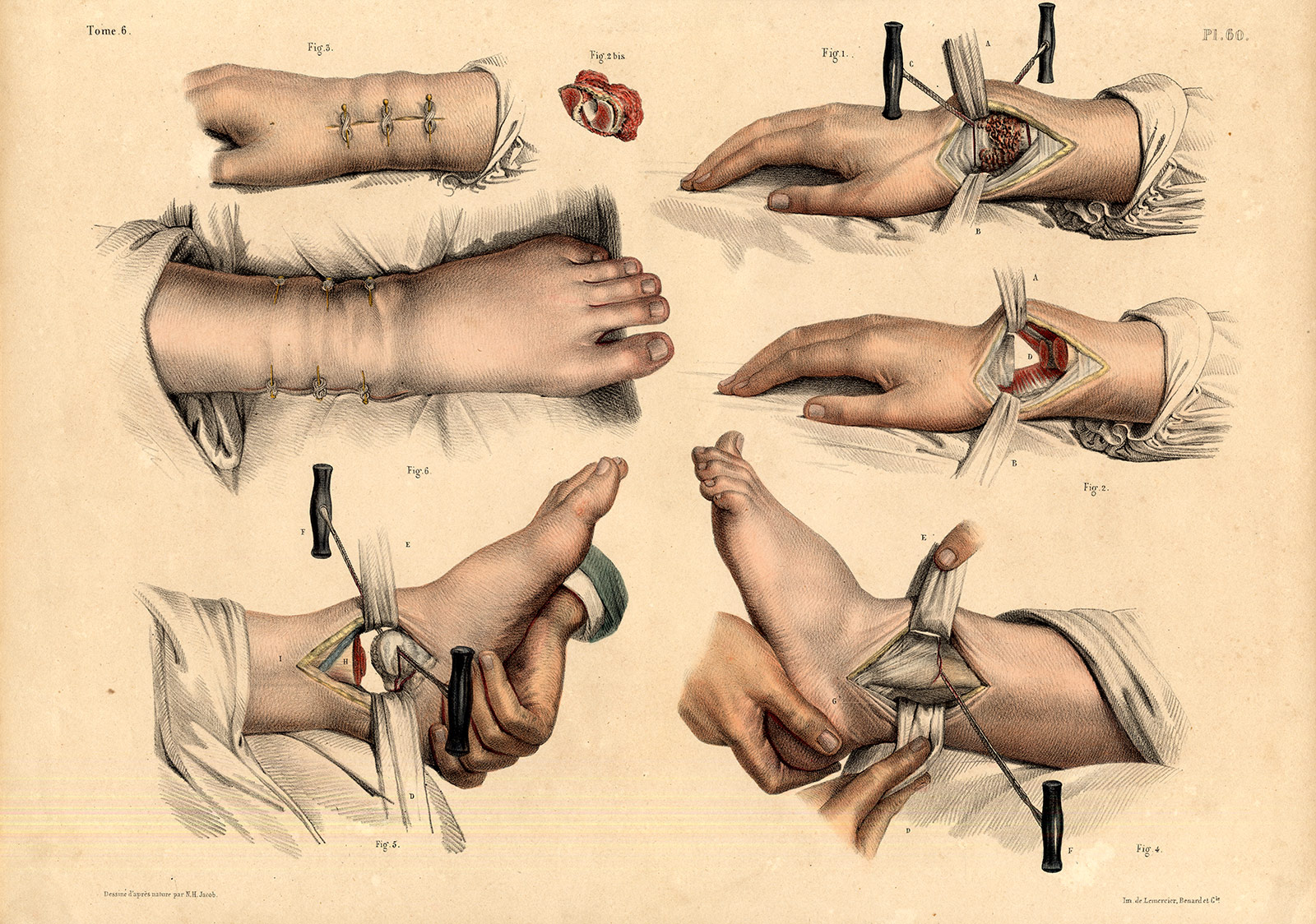 , 2 Antique Medical Anatomy Prints-RESECTION-TIBIOTARSAL JOINT-Pl 59-Bourgery-1831, Pictura Antique Prints