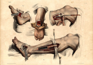 2 Antique Medical Anatomy Prints-RESECTION-PROCESS-JOINTS-Pl. 61-Bourgery-1831