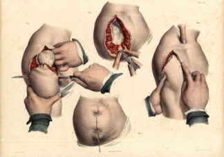 Antique Medical Anatomy Print-AMPUTATION-SCAPULOHUMERAL JOINT-P 78-Bourgery-1831