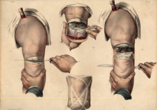 Antique Medical Anatomy Print-AMPUTATION-FEMORAL TIBIAL JOINT-P 84-Bourgery-1831