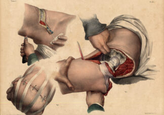 2 Antique Medical Anatomy Prints-AMPUTATION-COXOFEMORAL JOINT-P 87-Bourgery-1831