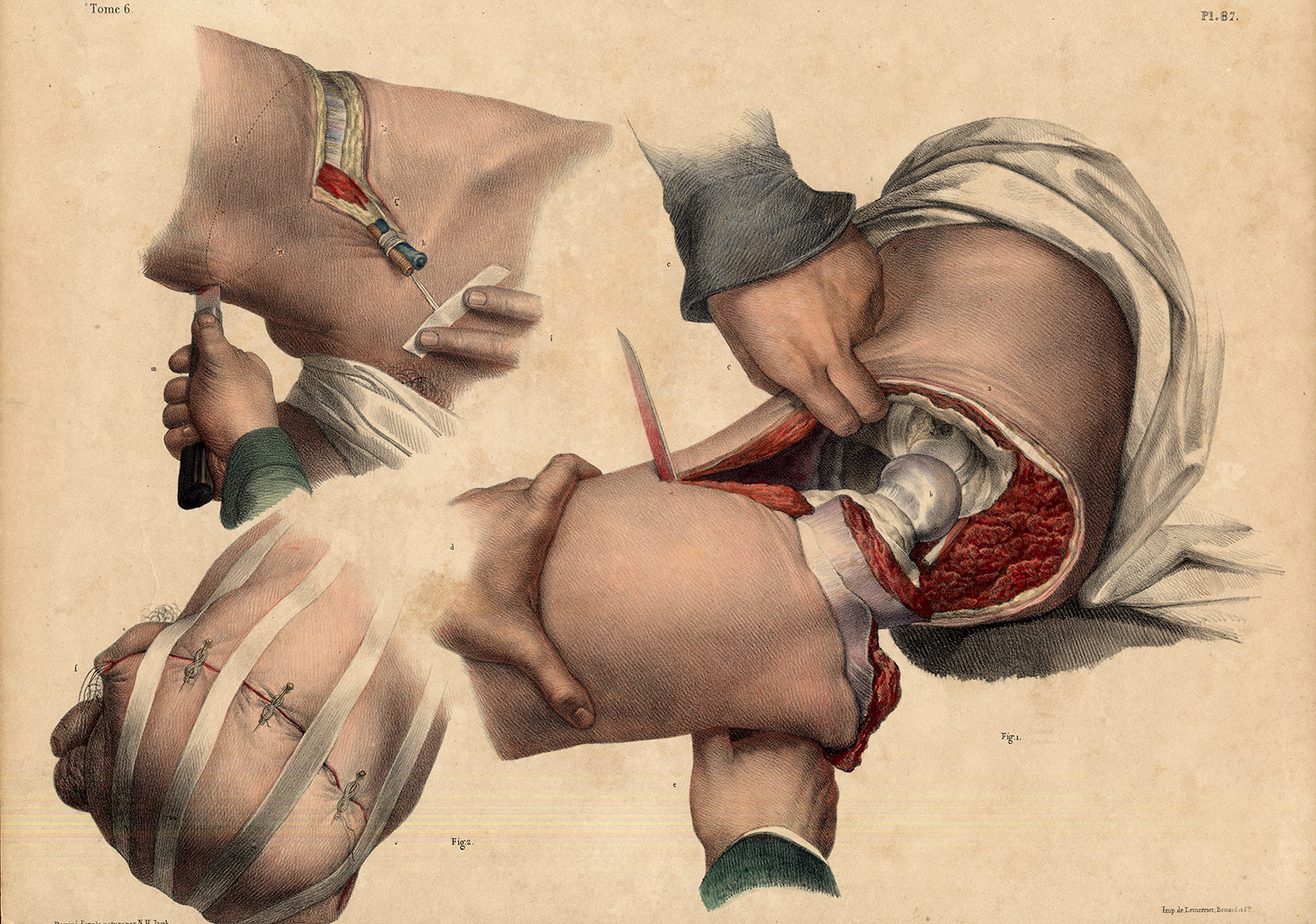 , 2 Antique Medical Anatomy Prints-AMPUTATION-COXOFEMORAL JOINT-P 87-Bourgery-1831, Pictura Antique Prints
