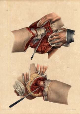 Antique Medical Anatomy Print-AMPUTATION-COXOFEMORAL JOINT-Pl. 90-Bourgery-1831