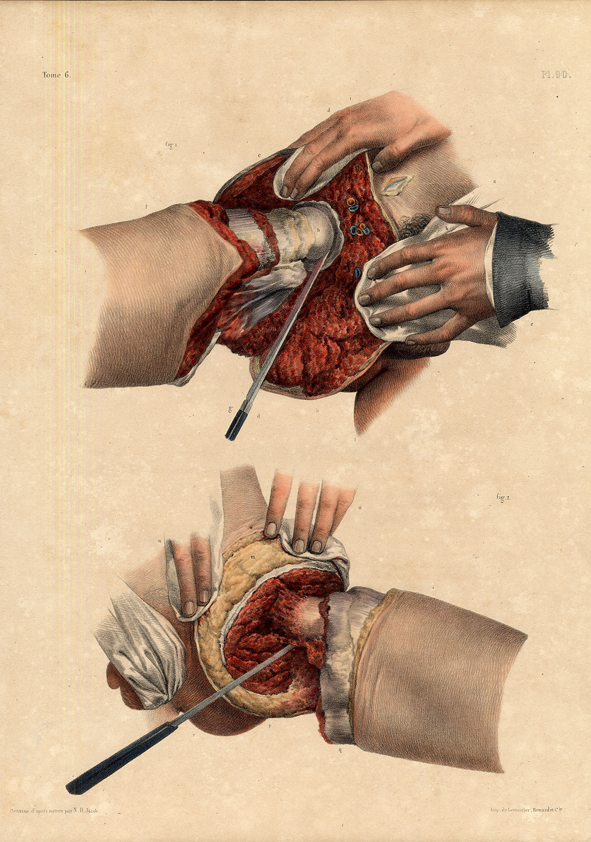 , Antique Medical Anatomy Print-AMPUTATION-COXOFEMORAL JOINT-Pl. 90-Bourgery-1831, Pictura Antique Prints