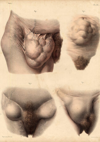 2 Antique Medical Anatomy Prints-HERNIA-FEMALE-BANDAGE-Pl. 36-Bourgery-1831