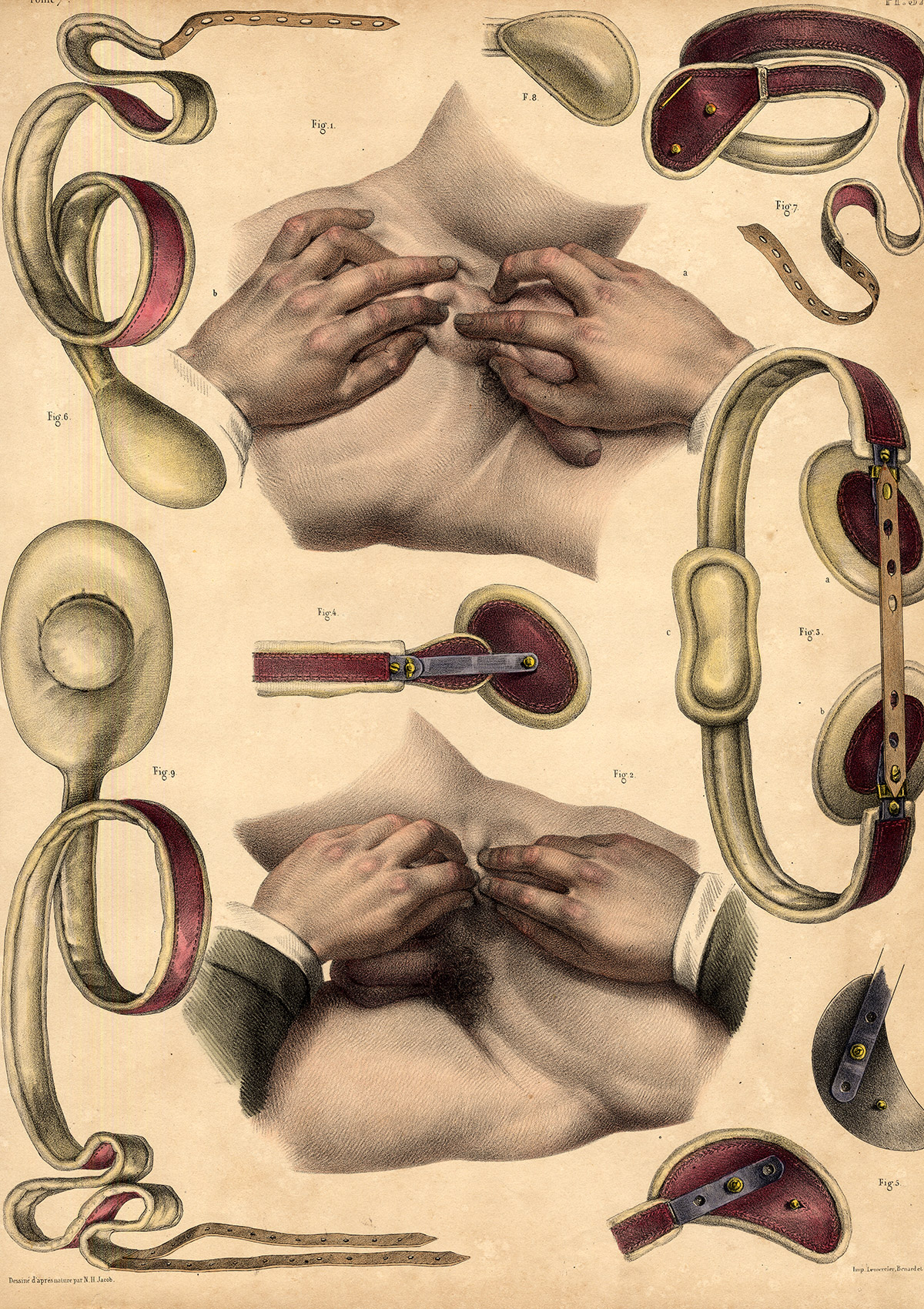 , 2 Antique Medical Anatomy Prints-HERNIA-FEMALE-BANDAGE-Pl. 36-Bourgery-1831, Pictura Antique Prints