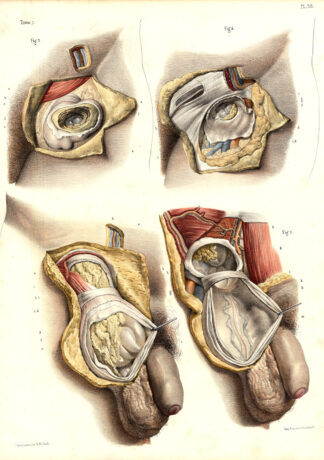 2 Antique Medical Anatomy Prints-HERNIA-ABDOMEN-INTESTINES-Pl. 38-Bourgery-1831
