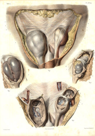 Antique Medical Anatomy Print-INGUINAL HERNIA-ABDOMEN-Pl. 38BIS-Bourgery-1831