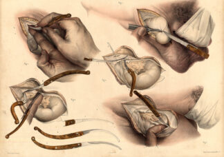 2 Antique Medical Anatomy Prints-STRANGULATED HERNIA-OPERATION-P40-Bourgery-1831